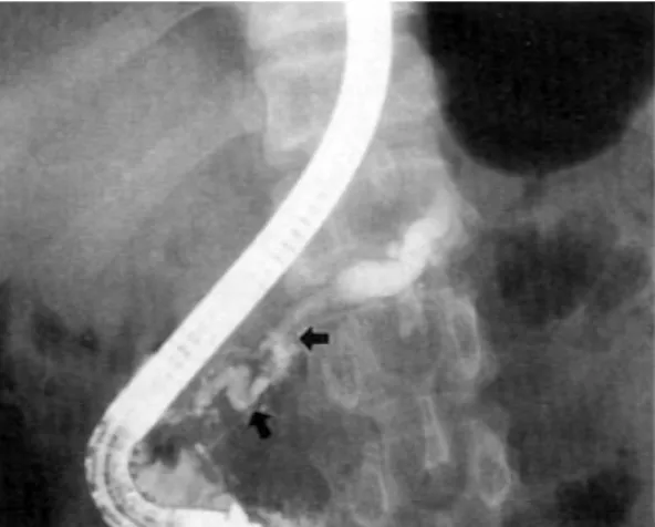 Fig. 2. An ERP finding taken 4 months later. Compared with previous examination, the main pancreatic duct around the neck portion is irregularly stenosed (between arrows) and its upstream is more dilated.