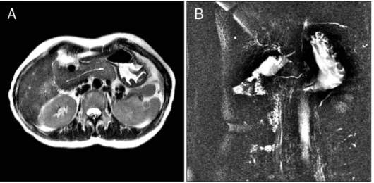 Fig. 2. MRI scan (A) and MRCP (B)  showing the main pancreatic duct and no accessory duct.