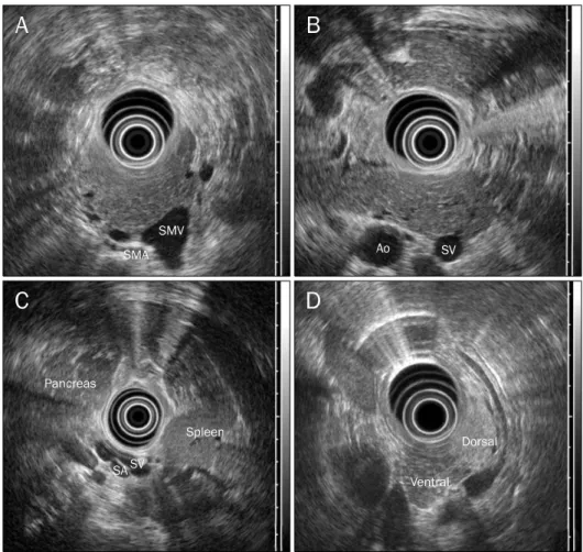 Fig. 3. EUS showing homogenous  echogenicity throughout the  pancrea-tic parenchyme (A), a hypertrophied  pancreatic head, the absence of the  accessory pancreatic duct (B), and  splenic vessels contacting the  pos-terior wall of the stomach (C)