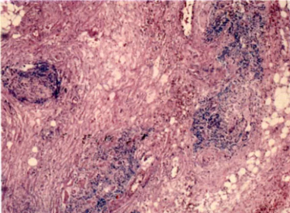 Fig. 5. Microscopic findings. Photomicrograph shows gra- gra-nulomatous inflammation with diffuse fibrosis and patchy lymphocyte infiltration (H&amp;E stain, ×40).