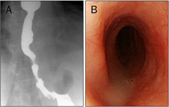 Fig. 2. High-resolution manometry showed rapid contractile front  velocity (CFV) attributed to spasm (12 cm/sec) throughout the distal esophageal segments.