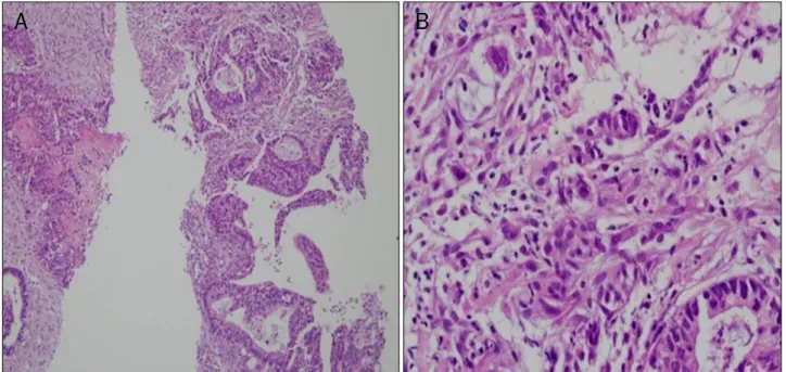 Fig. 5. Moderately differentiated adenocarcinoma was seen (H&amp;E). (A) ×100, (B) ×400