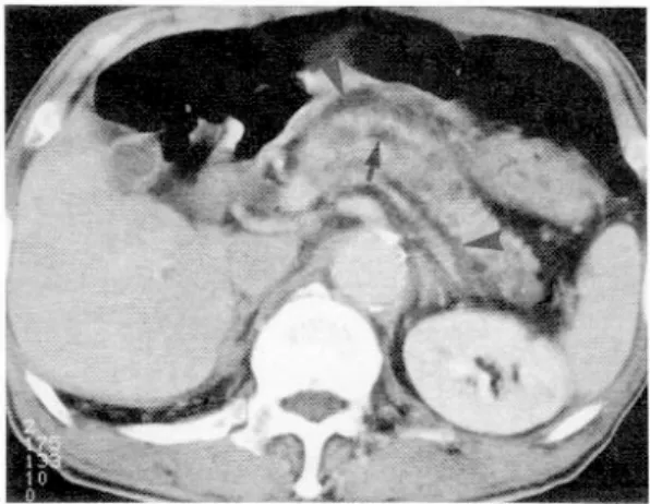 Fig. 2. Chronic pancreatitis. Abdominal CT shows irre- irre-gular dilated pancreatic duct (arrow), inflammation at the pancreas and peripancreatic fat tissue (arrow head).