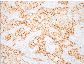 Fig. 2. Microscpic image of H&amp;E (×100). Invasive ductal carcinoma with prominent desmoplastic response and comedo necrosis was  present (arrow)