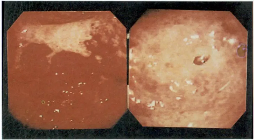 Fig. 1. Gastroscopic findings. Tumor-like obstruction with diffuse mucosal edema, multiple ulcers and erosions are shown at antrum.