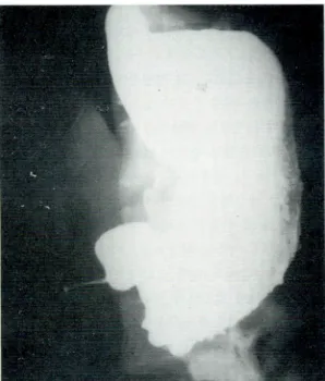 Fig. 3. Abdominal CT scan. Marked submucosal thick- thick-ening at (arrow) antrum causes obstruction.