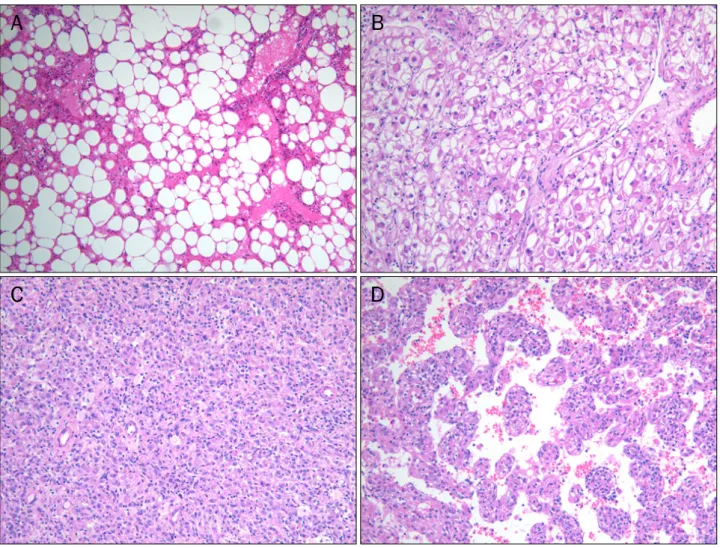 Fig. 2. Variable histologic features of hepatic angiomyolipoma (H&amp;E stain). (A) Predominantly lipomatous component was identified in one case  (×40)