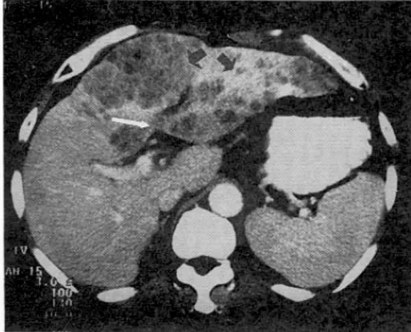 Fig. 1. CT-scan at the time of diagnosis of hepatocellular carcinoma. It shows findings compatible with cirrhosis: