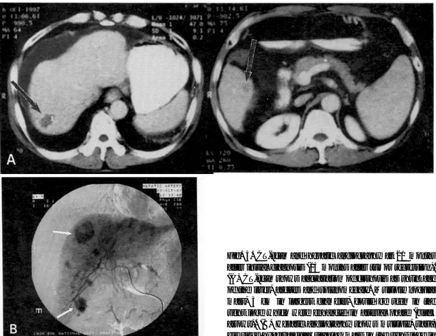 Fig. 3. CT-scan and hepatic angiography at 21 months after initial diagnosis (15 months after tumor regression).