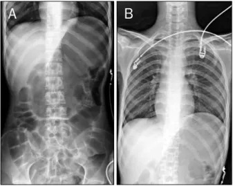 Fig. 1. (A) Severe gastric gaseous distention was noted on plain  abdominal radiograph