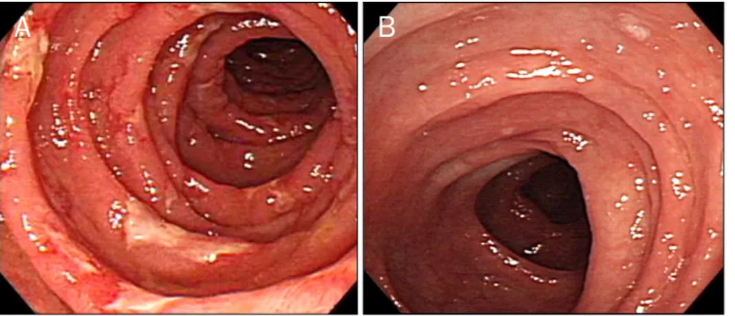 Fig. 2. Endoscopic findings. (A) It  showed multiple shallow ulcers in the duodenal second portion