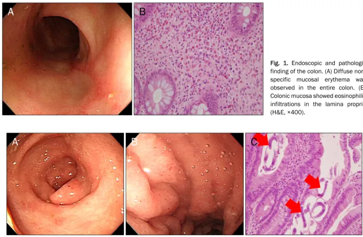 Fig. 1. Endoscopic and pathologic  finding of the colon. (A) Diffuse non-  specific mucosal erythema was  observed in the entire colon