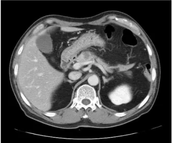 Fig. 1. Initial outside abdominal CT scan showed ill-defined low  attenuated lesion in the pancreatic body.