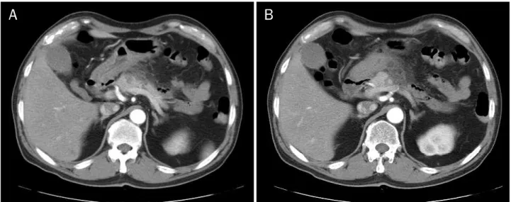 Fig. 2. Abdominal CT scan was checked again 4 days later. Peripancreatic infiltration was worse than before.
