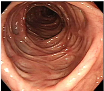 Fig. 4. Follow up colonoscopy finding. There were scars with  pseudodiverticuli at the ascending colon after 6 years.