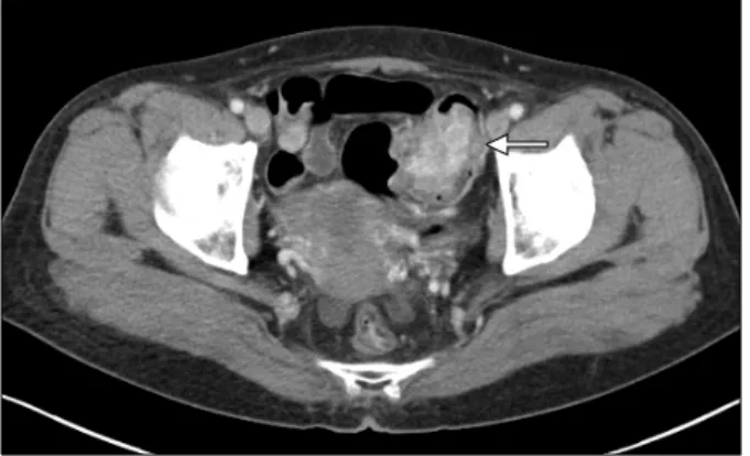 Fig. 1. Abdominopelvic CT finding. An about 5 cm sized enhancing  fungating  mass  (white  arrow)  was  seen  on  the  sigmoid  colon
