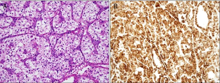 Fig. 4. Microscopic finding. (A) H&amp;E stain (×400) showed the sheet-like growth of nests of epithelioid cells with an alveolar appearance