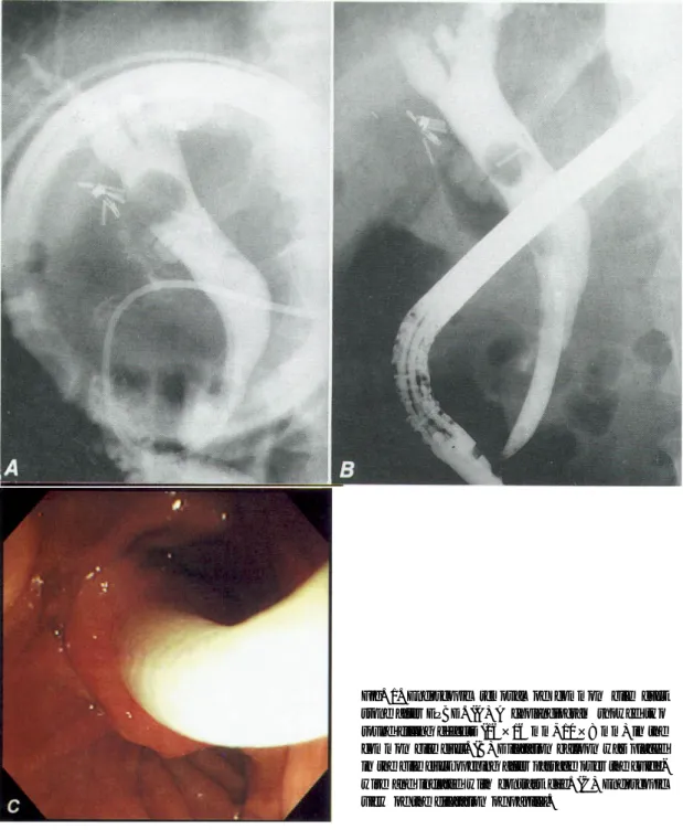 Fig. 1. Endoscopic removal of common bile duct stone after EPBD. (A) A cholangiogram showed two round filling defects (16×16 mm, 10×8 mm) in the common bile duct