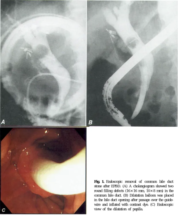 Fig. 1. Endoscopic removal of common bile duct stone after EPBD. (A) A cholangiogram showed two round filling defects (16×16 mm, 10×8 mm) in the common bile duct