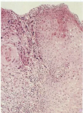 Fig. 5. Endoscopic biopsy. Moderately differentiated invasive squamous cell carcinoma with keratin pearl formation (H&amp;E stain, ×200).