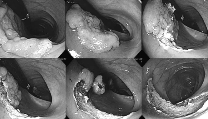 Figure 4. Piecemeal endoscopic mucosal resection. 
