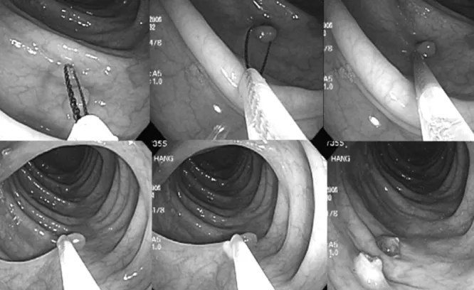 Figure 1. Conventional snare polypectomy.