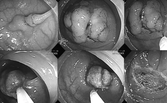 Figure 2. Endoscopic mucosal resection. 