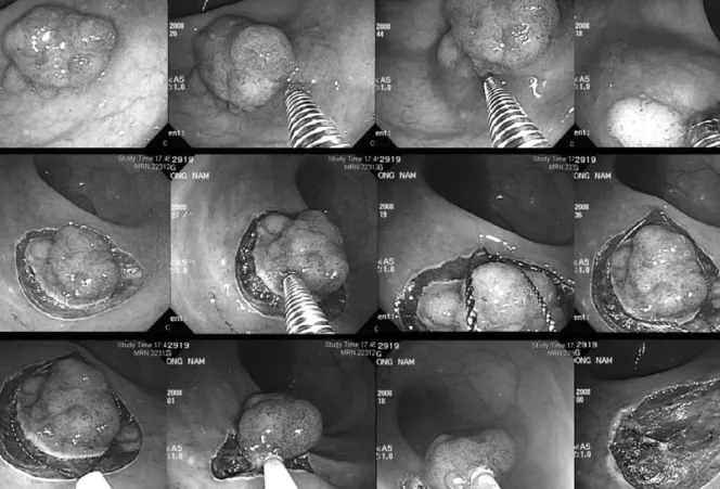 Figure 3. Endoscopic mucosal resection with precutting. 