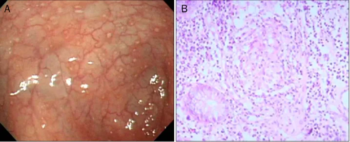 Fig. 1. Colonoscopic and microscopic findings of sigmoid colon. (A) It showed aphthous ulceration 35 cm from anal verge