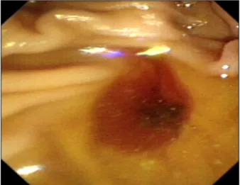 Fig. 2. Bleeding from ampulla of Vater was observed during duoden- duoden-oscopy.발생하는  경우는  매우  드물다
