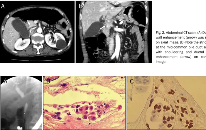 Fig. 3. Imaging and histologic findings of the common bile duct. (A) Endoscopic retrograde cholangiography revealed a concentric, abrupt  narrowing of the mid-common bile duct
