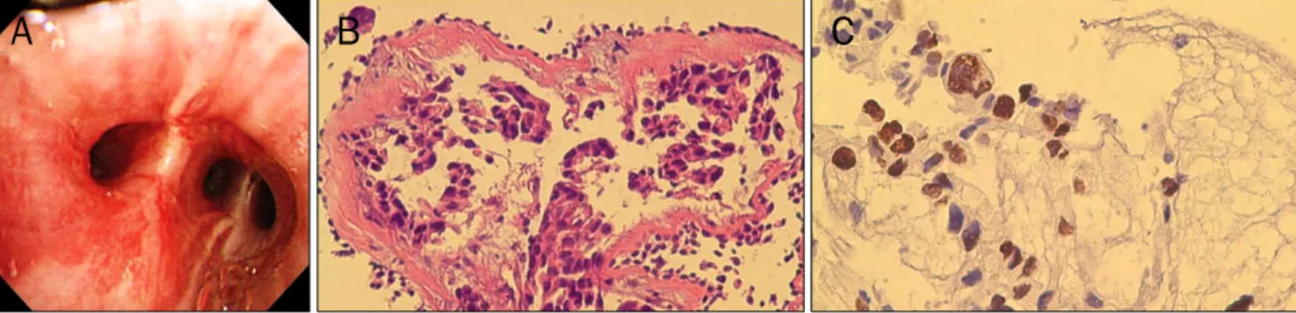 Fig. 4. Bronchoscopic findings and bronchial biopsy specimen. (A) Bronchoscopy showed hyperemic mucosal change, finding suspicious of  cancer cell infiltration
