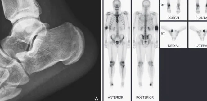 Figure 1. A patient with calcaneal stress fracture. (A) A lateral foot plain radiograph shows no definite fracture line on calcaneus.