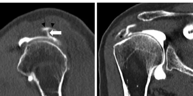 Figure 3. A patient with full-thickness tears of supraspinatus tendon. Oblique sagittal reformatted (A) and oblique coronal refor- refor-matted (B) image of shoulder CT arthrography show contrast material which injected into glenohumeral joint traverse (ar