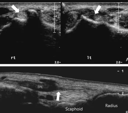Figure 4. A patient with complete tear of extensor pollicis longus tendon (EPL) A.