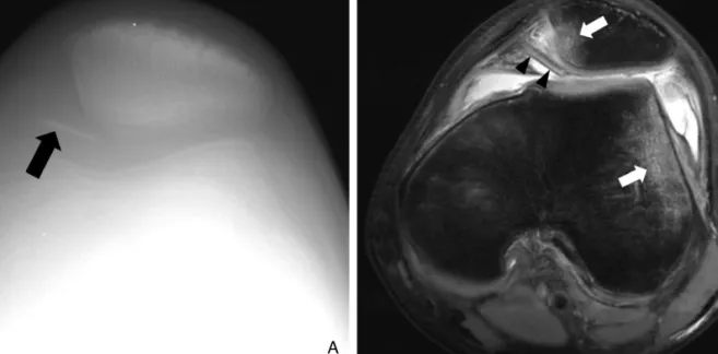 Figure 6. A patient with transient patellar lateral subluxation. (A) Patellar skyline view of right knee shows linear increased opacity parallel to medial patellar facet (arrow) representing osteochondral fracture fragment