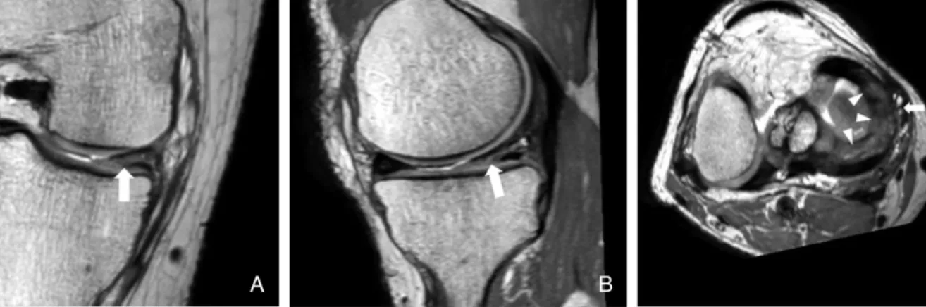 Figure 7. A patient of medial meniscus horizontal tear. Proton density weighted coronal (A), sagittal (B), and transaxial (C) images show intrameniscal linear high signal intensity area which extend to inferior articular surface (arrows in A and B, arrowhe