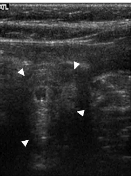 Fig. 4. Pathologic findings (H&amp;E). (A) A gastric duplication cyst (×100). The wall had mucus producing glands internally (right lower part), and smooth muscle externally (left upper part)