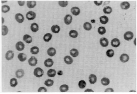 Fig. 1. Peripheral blood smear of patient 1. Normocytic normochromic red cells with moderately decreased platelet counts and two young platelets are noted (Wright stain, × 1000).