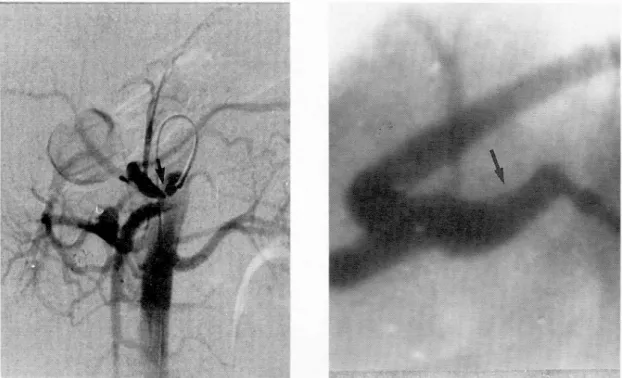 Fig. 1. Abdominal aortogram. Abdominal aortogram shows smooth narrowing of the celiac artery close to its origin with dominant splenic artery flow, collateral vessels  be-tween superior mesenteric artery and hepatic artery and arterial aneurysm at the gast