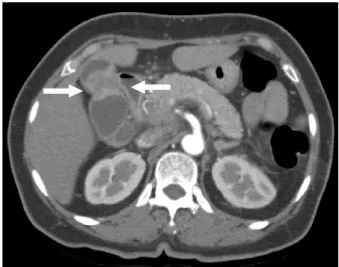 Fig. 2. CT finding of second patient (wife). A 2×2 cm sized mass lesion (arrow) in the gallbladder body with enhanced wall thickening.