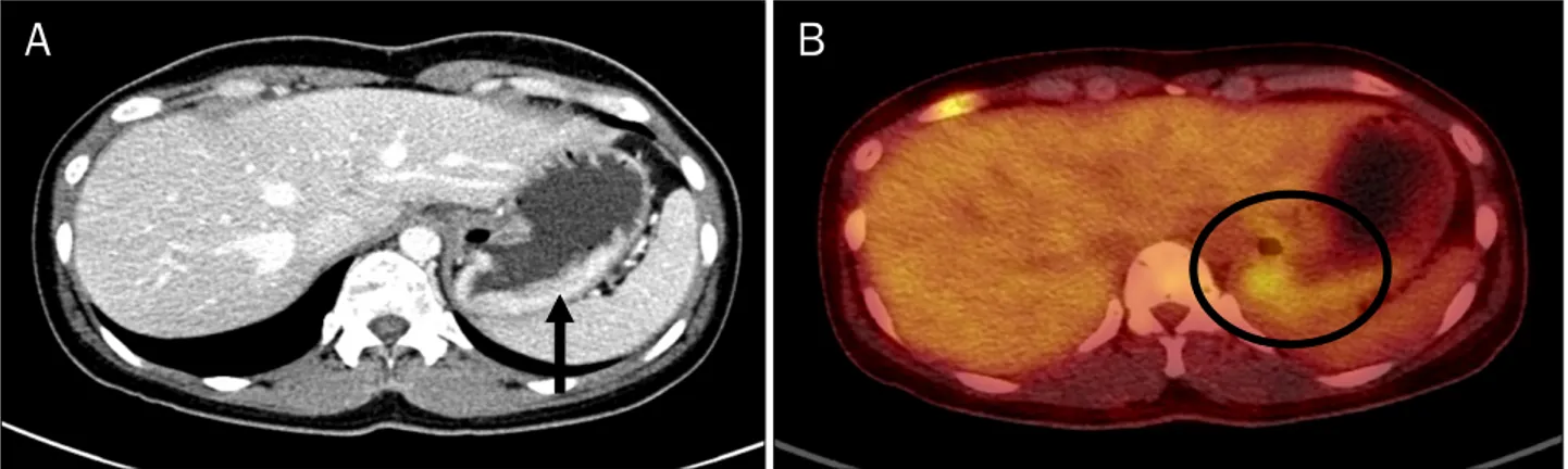 Fig. 1. Abdominal CT and PET-CT findings. (A) Diffuse wall thickening and enhancement (black arrow) were seen on the fundus