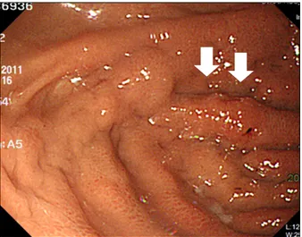 Fig. 3. Microscopic findings of the gastric biopsy. (A) It showed diffuse infiltrated adenocarcinoma with signet ring cell feature, consistent with metastatic lobular carcinoma with signet ring cell feature from the breast (H&amp;E, ×200)
