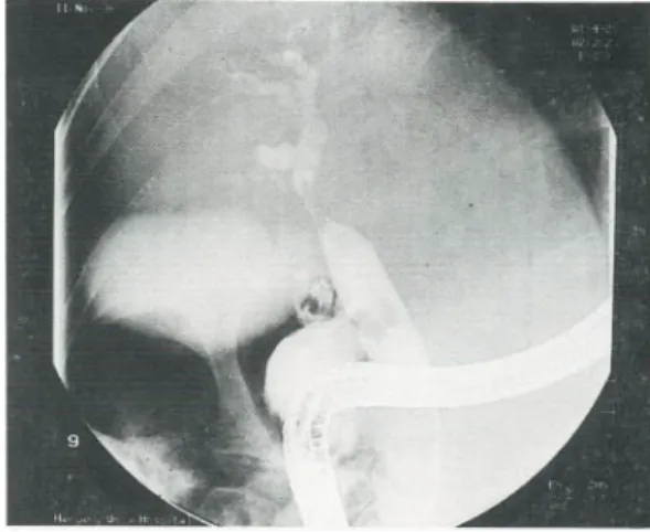 Fig. 1. ERCP findings: extrinsic compression of common hepatic duct with tubular filling defect is seen (case 1).