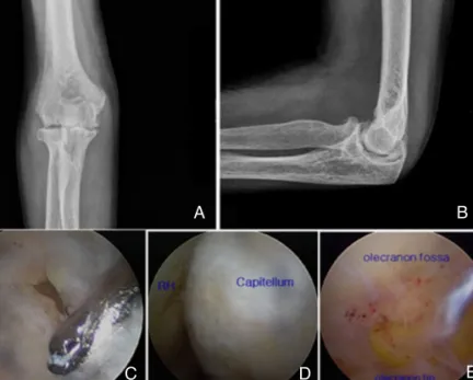 Figure 1. (A) and (B) show radiographs of an elbow with rheumatoid arthritis. There is diffuse joint space narrowing and subchondral osteopenia; (C), (D) and (E) Arthroscopic synovectomy and debridement was perfomed