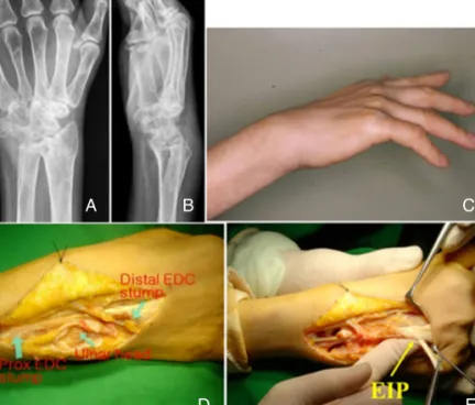 Figure 2. (A), (B) Wrist radiograph of a 56-year-old woman showing a destructive change in the wrist joint