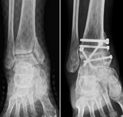 Figure 3. A 29 - year - old woman with rheumatoid arthritis. (A) Anteroposterior radiograph of the right ankle shows arthritic change with a medial malleolar fracture caused by trauma