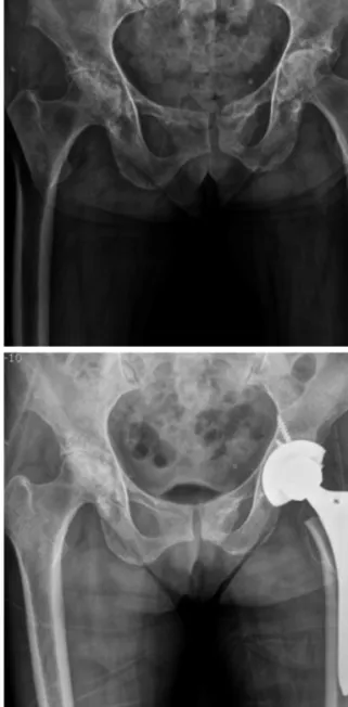 Figure 4. (A) A 39-year-old woman with rheumatoid arthritis had severe arthritic changes and valgus deformity in the left knee joint