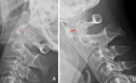 Figure 6. (A) Extension and (B) flexion radiograph of the cervical spine shows atlantoaxial subluxation