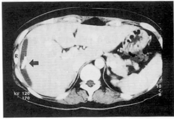 Fig. 2. Abdominal CT finding. After percutaneous drai- drai-nage with a 10 F catheter (arrow), the subcapsular  hema-toma was markedly reduced.